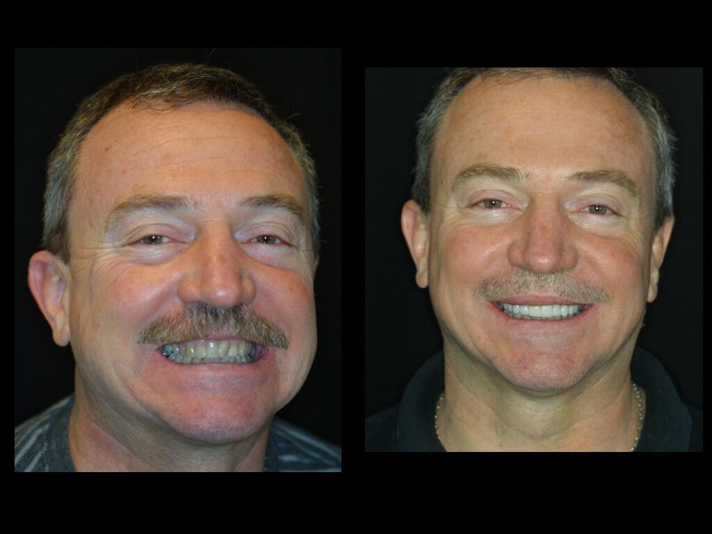 Claudio - Dental Patient - Before and After Veneers