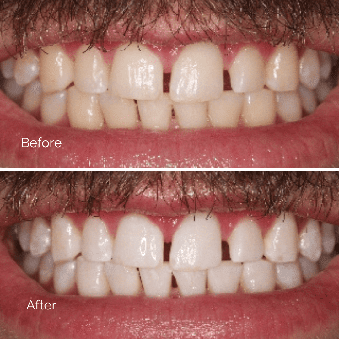 Before and After Teeth Bleaching