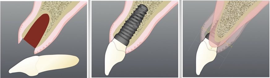 Implant placement process