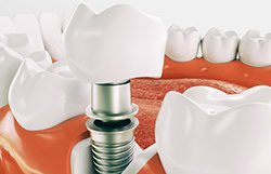Dental Implant Osseointegration & Abutment