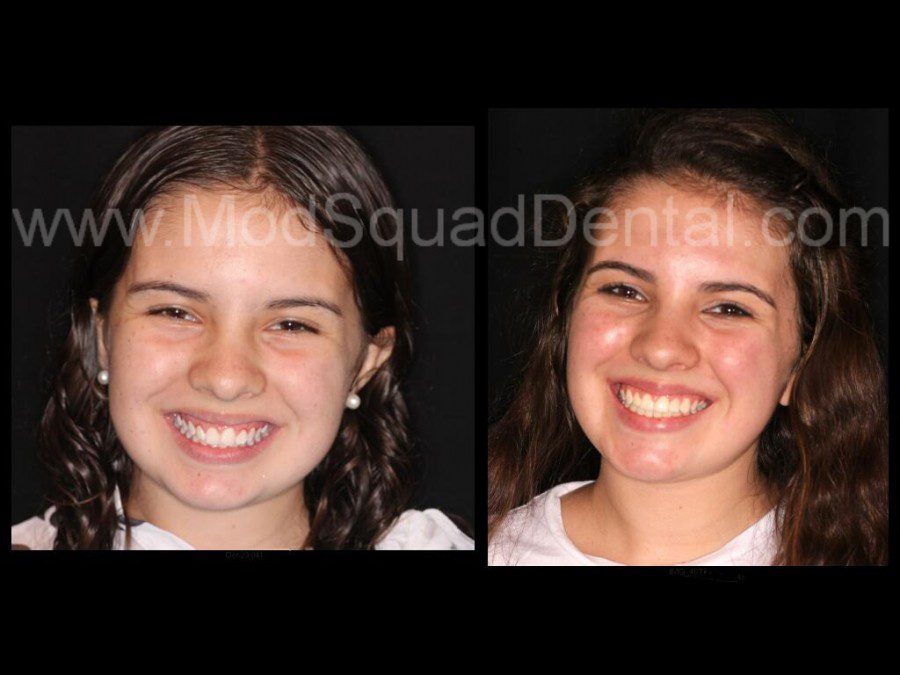 Before and after putting braces