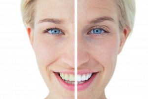Before and after Teeth whitening procedure