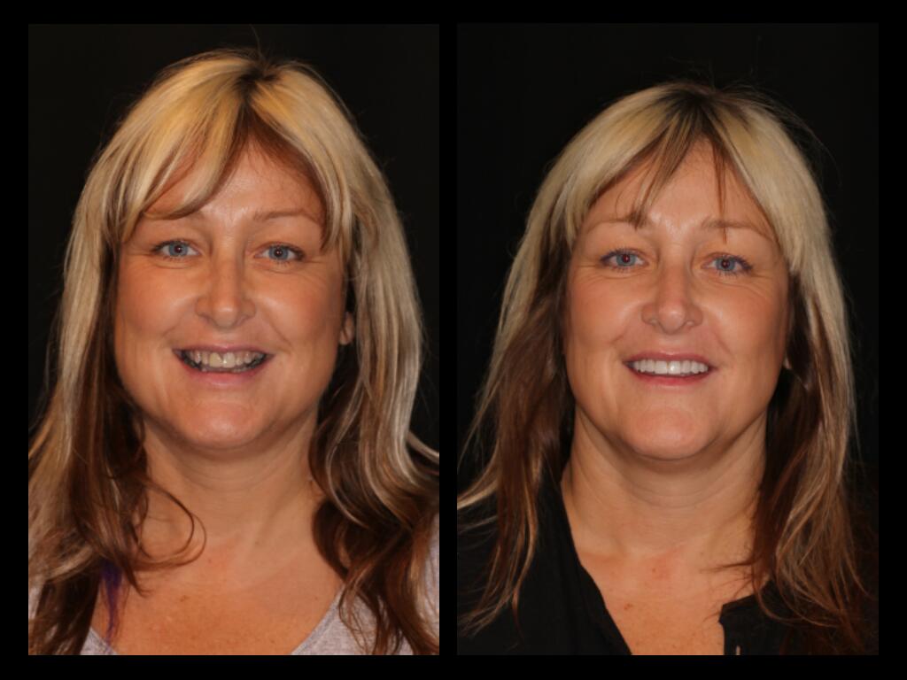 Anne before and after dental treatment