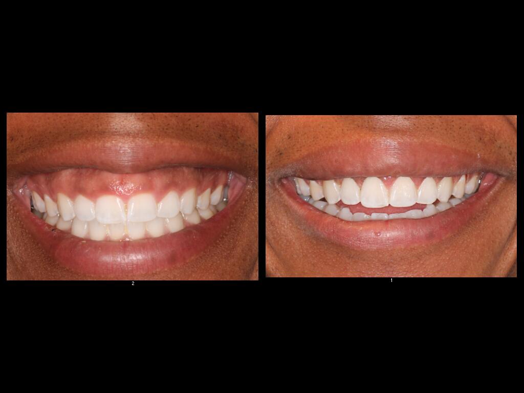 Before and After dental treatment