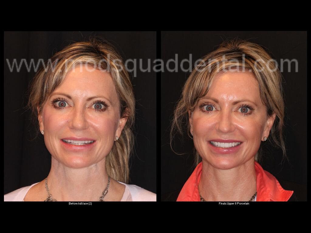 Collins Before and After Dental Treatment