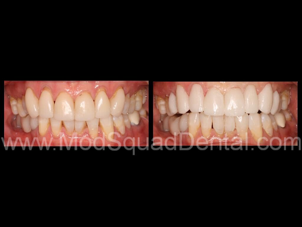 Elizabeth before and after dental treatment