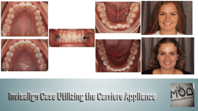 Featured Smile Utilizing Invisalign & Carriere Appliance