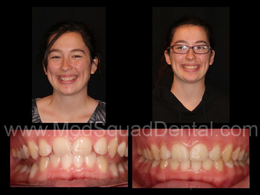 Before and after TMJ treatment