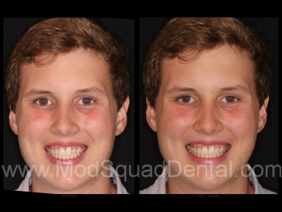 Before and after putting porcelain veneers