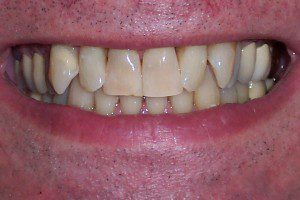 Dental Patient - After bleaching cream