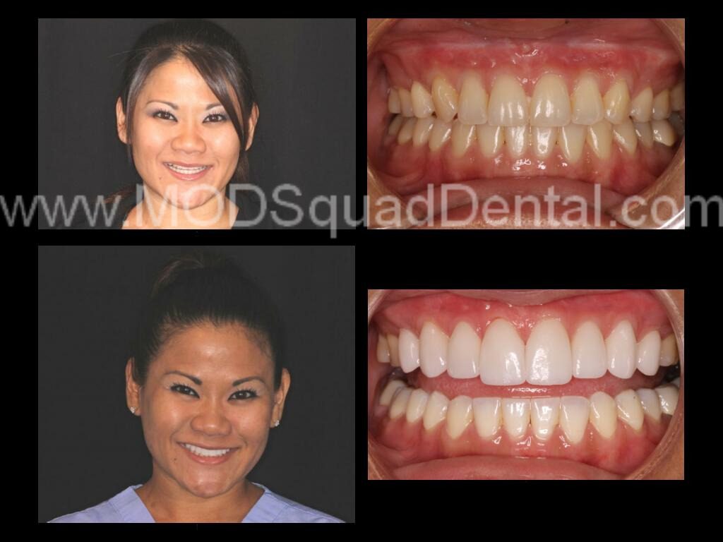 K. Kosh before and after dental treatment
