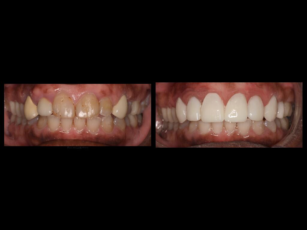 Lena Taylor teeth before and after treatment