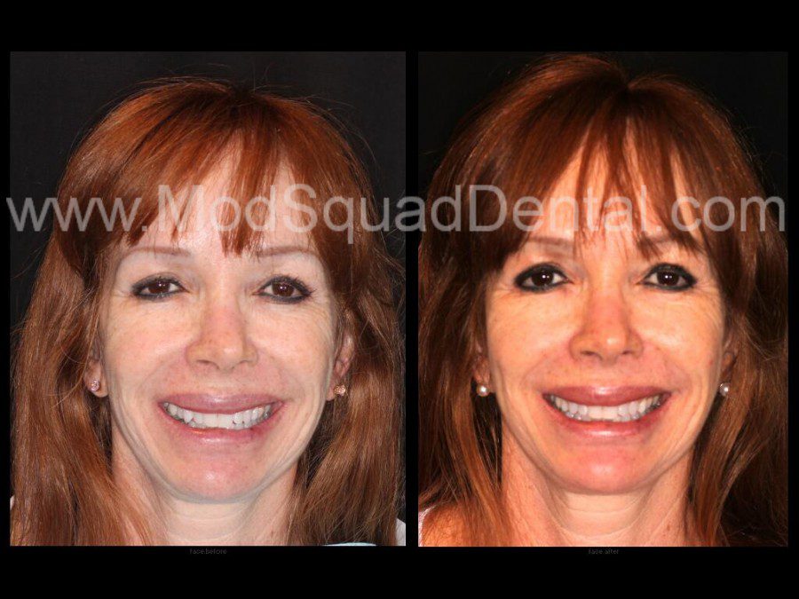Before and after 6 months Orthodontics