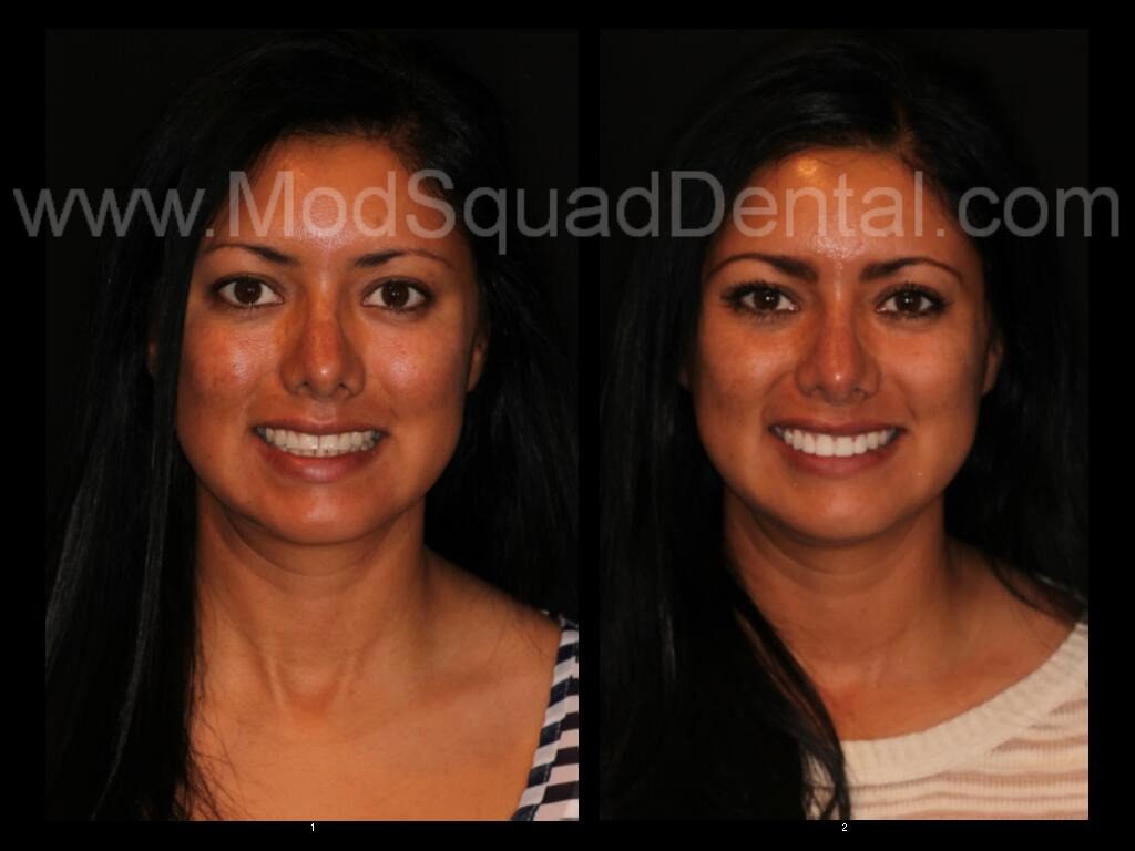 Monica before and after dental treatment