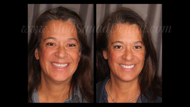 Stunning before and after smile makeover