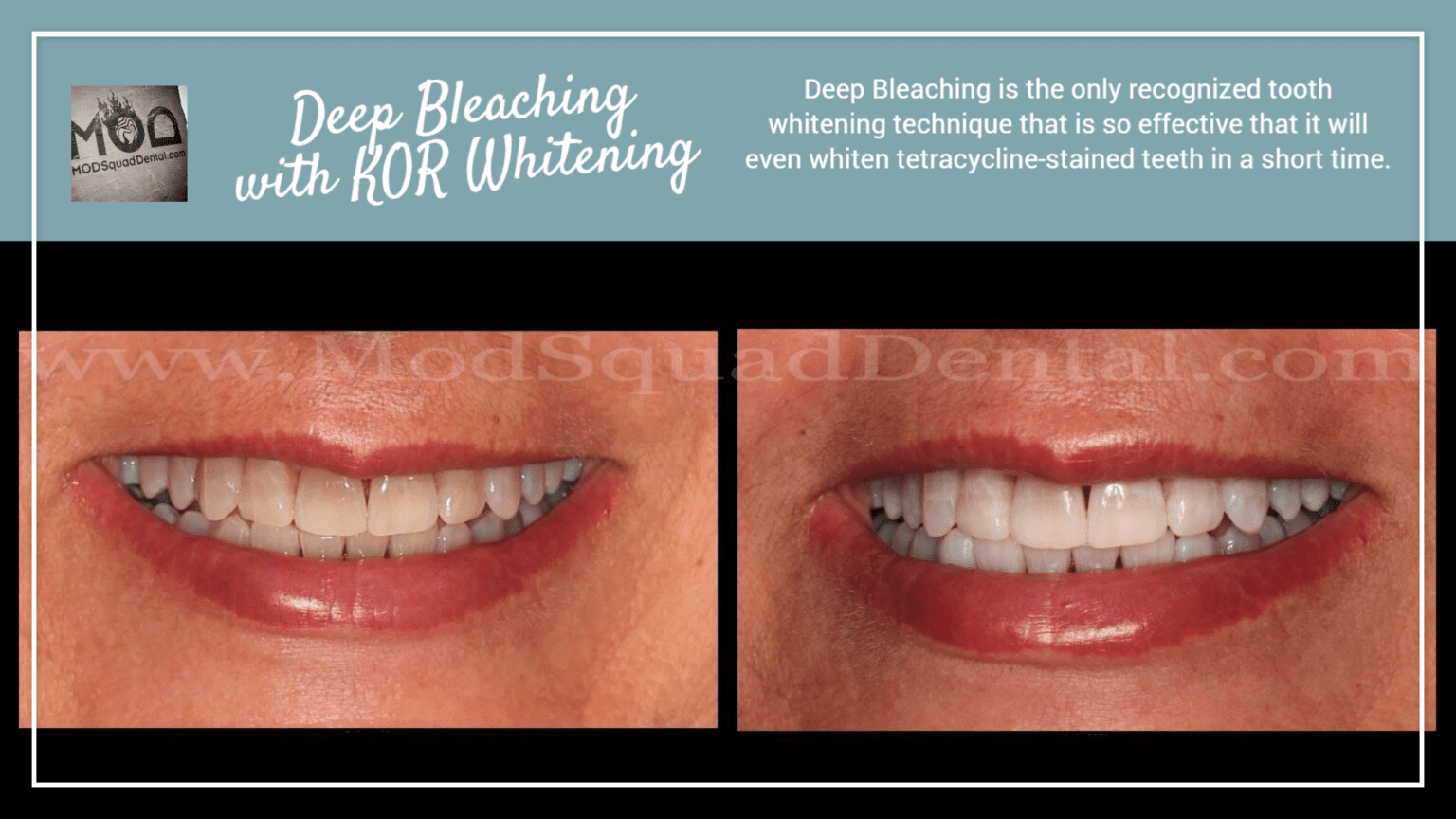 Deep Bleaching Kor Teeth Whitening
