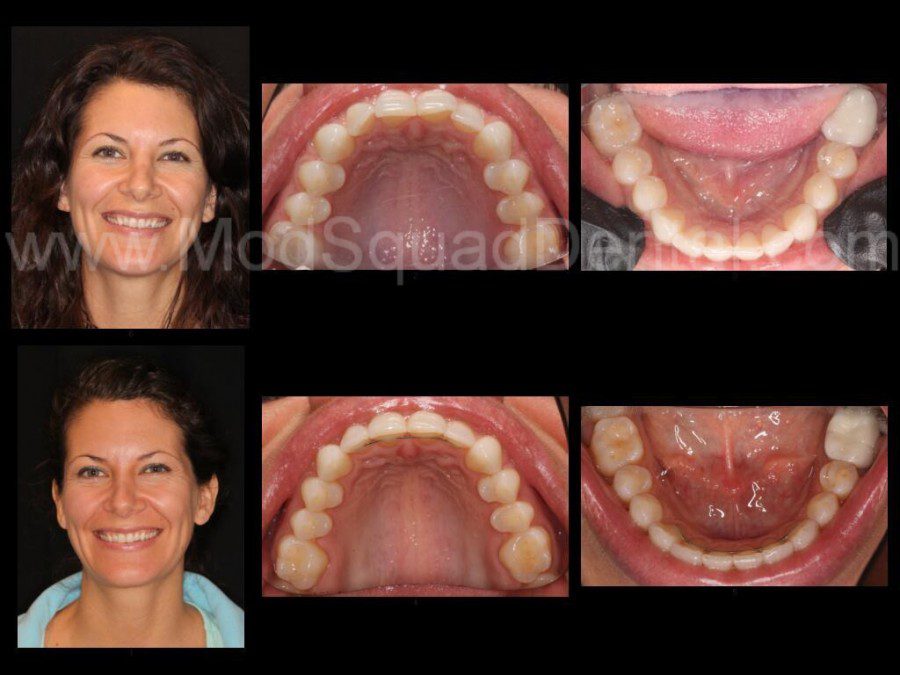 Before and after Invisalign procedure