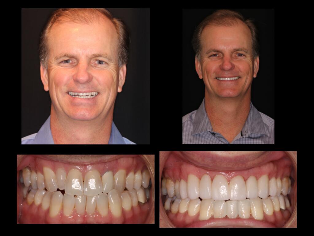 Steve DeLong before and after dental treatment