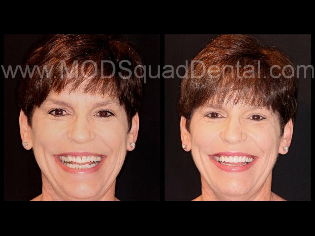 How can porcelain veneers improve one's smile