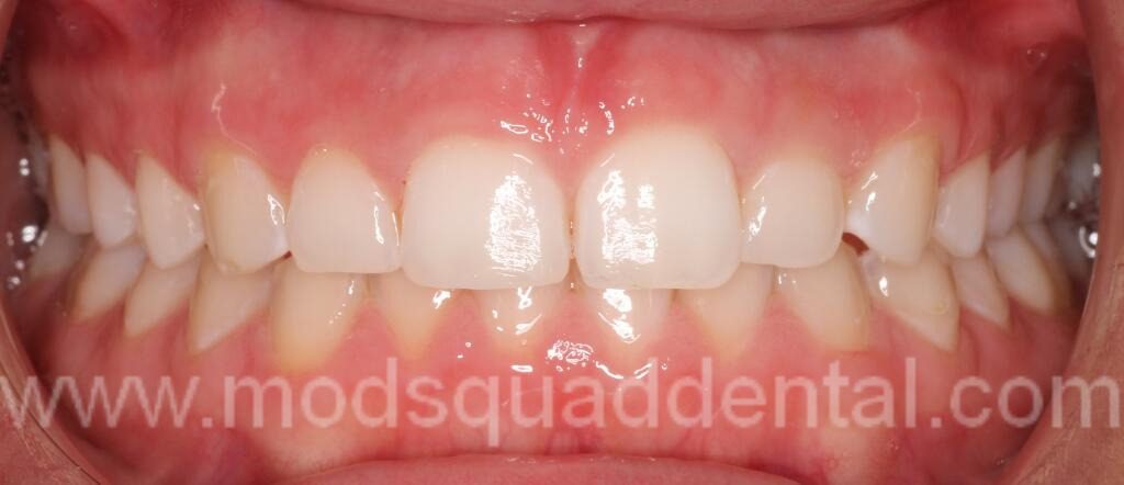 BEFORE PHOTO-UPPER 4 LASER GINGIVECTOMY