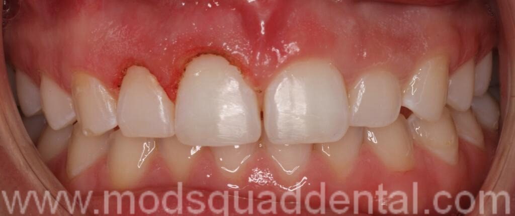 RIGHT SIDE LASER GINGIVECTOMY COMPLETED