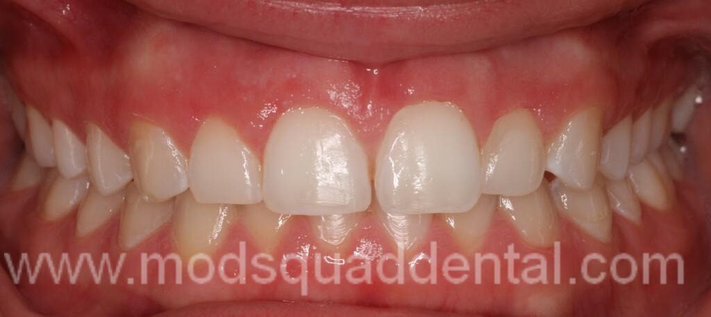 ONE WEEK AFTER LASER GINGIVECTOMY UPPER 4 TEETH
