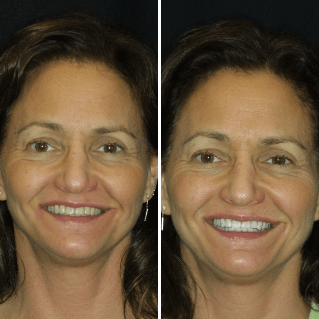 Before and After Zoom Smile Patient