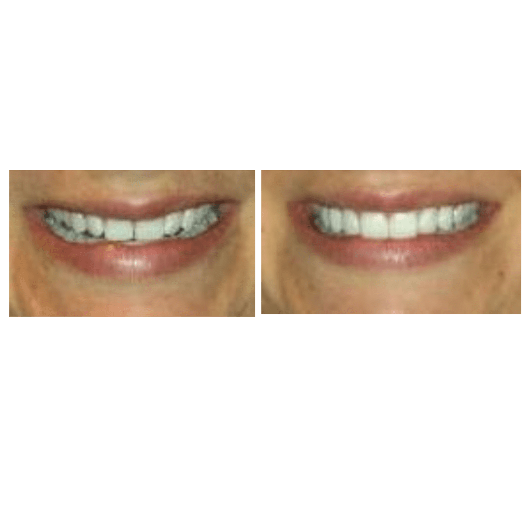 Before and After - Dental Veneers Patient