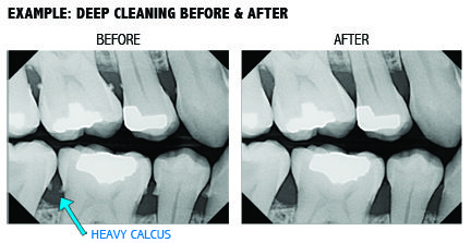 Deep cleaning xray result
