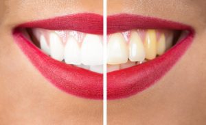 Before and after Teeth whitening procedure