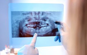 Dental Implants Post-Op Instructions