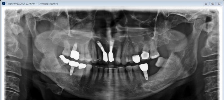 Dental X-ray with several implants