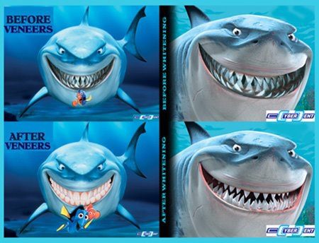 Shark illustration dental veneers