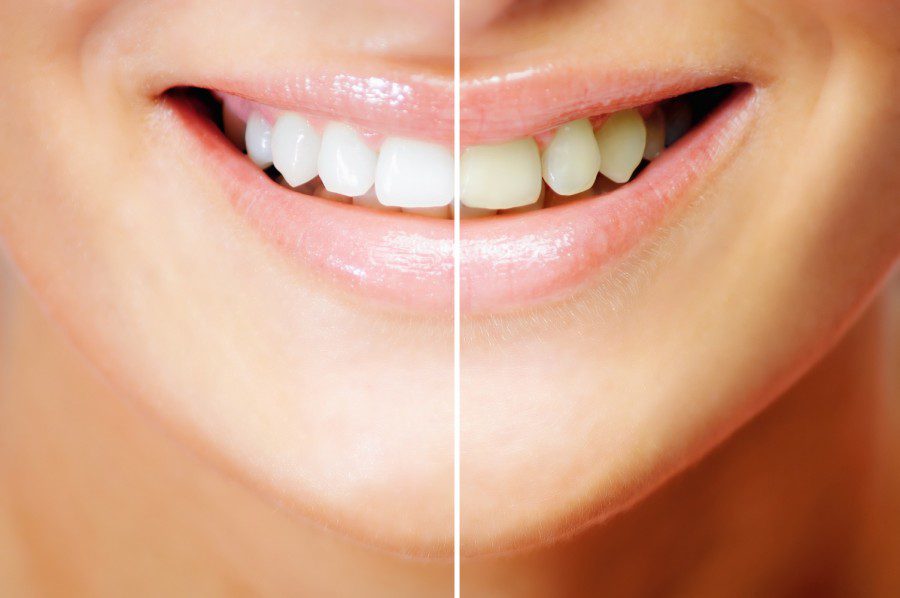 Teeth Whitening results