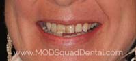 Before a treatment's teeth appearance