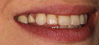 picture of the teeth that needs treatment