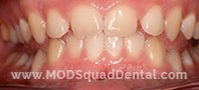 Picture of the teeth with TMJ