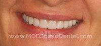 Teeth with veneers