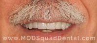 Picture of the teeth with Veneers