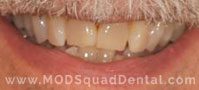 A teeth without veneers