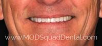 Steve's teeth after the treatment