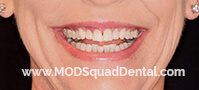 Suzanne's teeth before the treatment