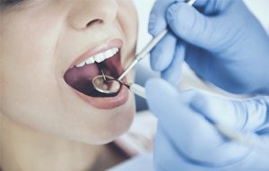 How are tooth-colored fillings placed?