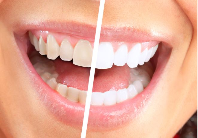 KOR Deep Bleaching - The Number 1 Teeth Whitening Procedure Recommended by Dental Professionals...
