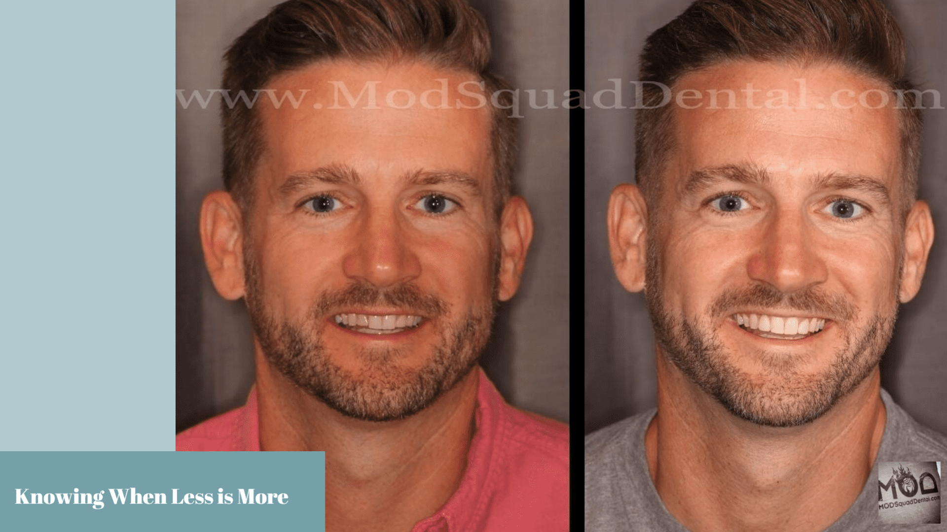 Featured Smile Makeover Courtesy of Dr. Friedman...